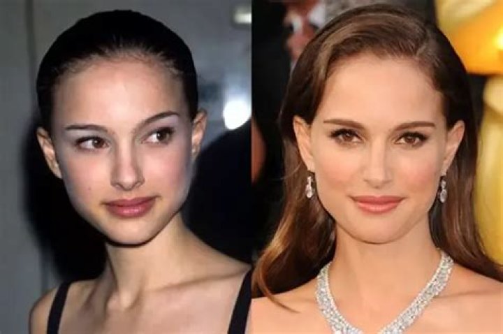 Natalie Portman Nose Job Plastic Surgery Before And